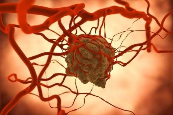 研究新发现：生姜或成为癌症克星 ()